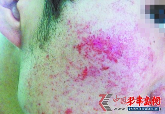 小馮面部嚴(yán)重過(guò)敏,布滿(mǎn)了紅疙瘩。 小馮面部嚴(yán)重過(guò)敏,布滿(mǎn)了紅疙瘩。